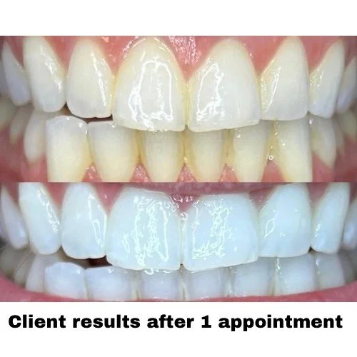 Close-up of a person's teeth before and after teeth whitening, showing significant whitening improvement after one appointment. New Prague