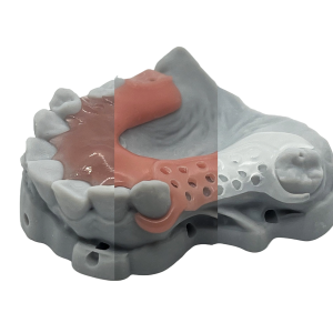 Flexible Partial Frame with Model 