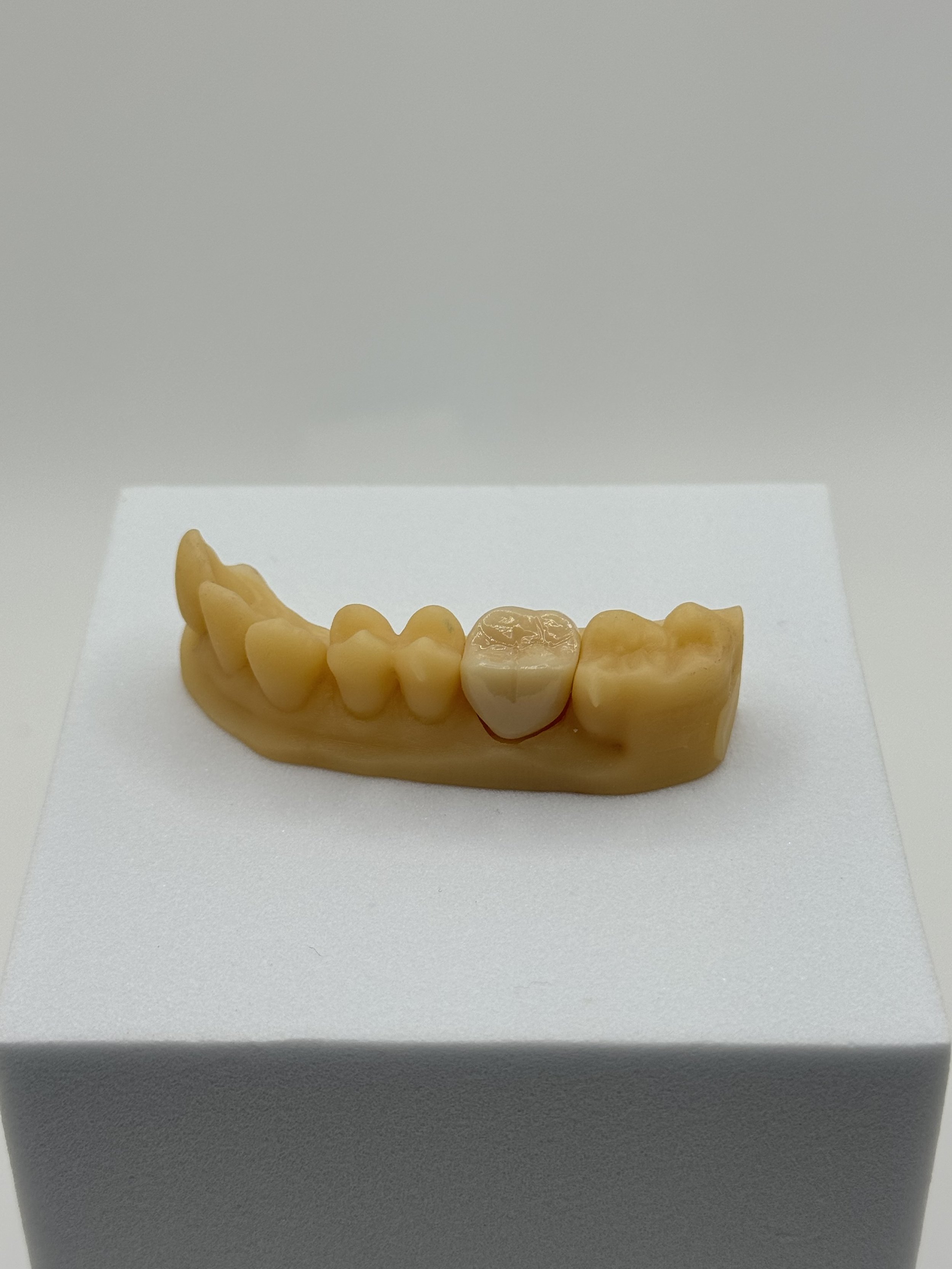 Full Contour Zirconia - Single Unit Crown