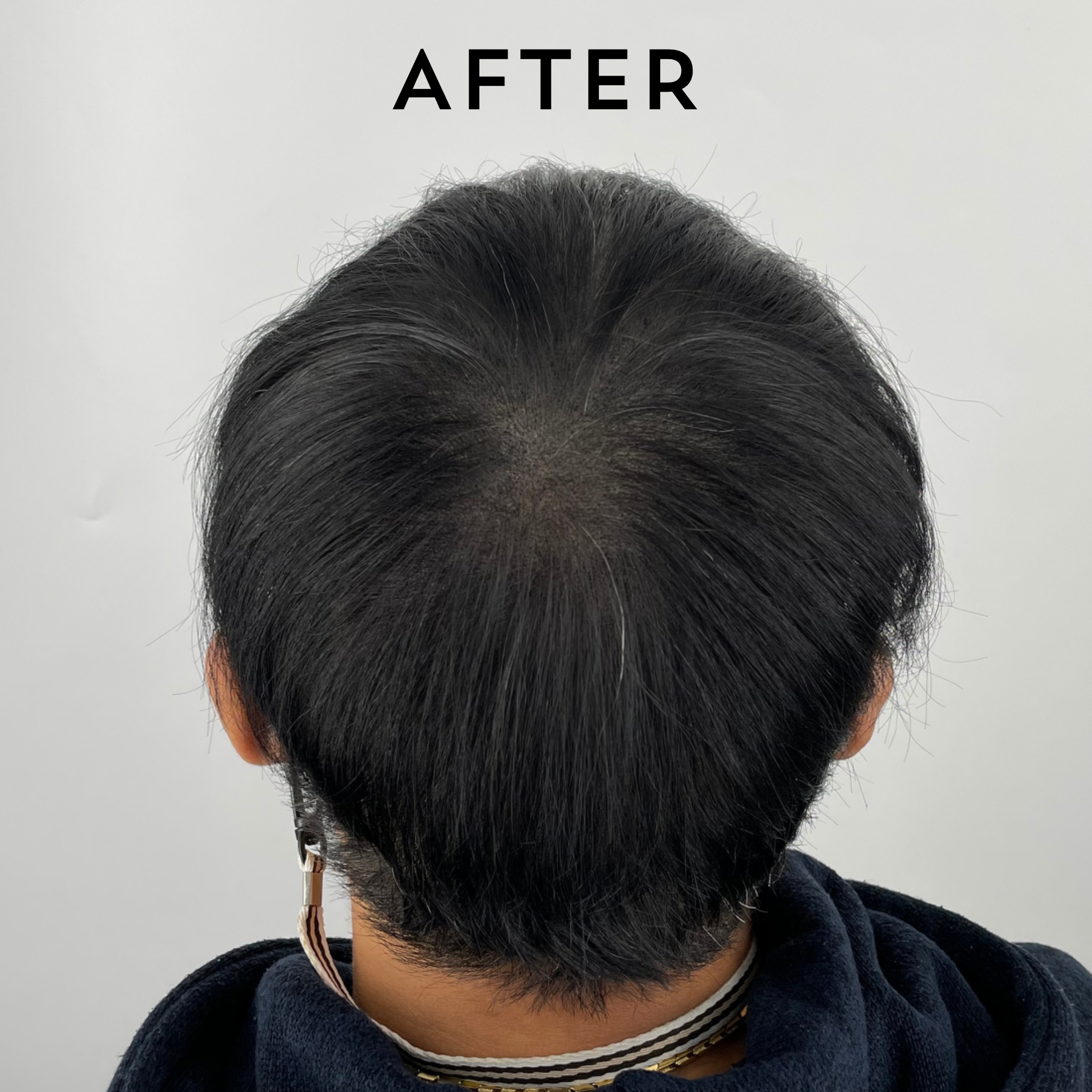 hair loss, smp, alopecia, hair growth