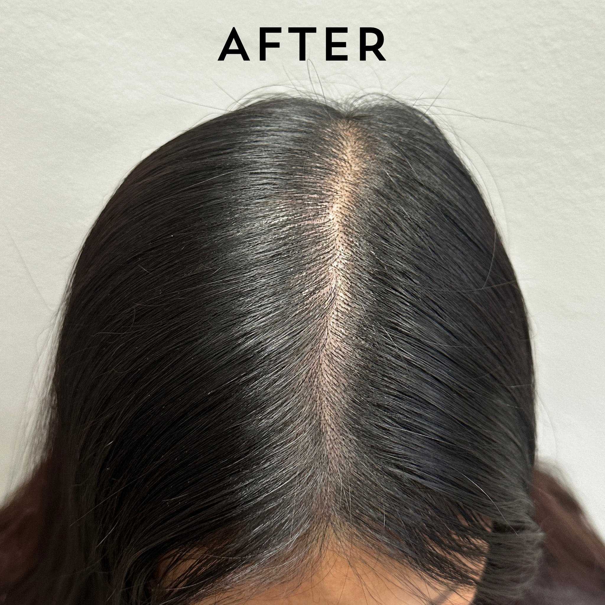 hair loss, smp, alopecia, hair growth