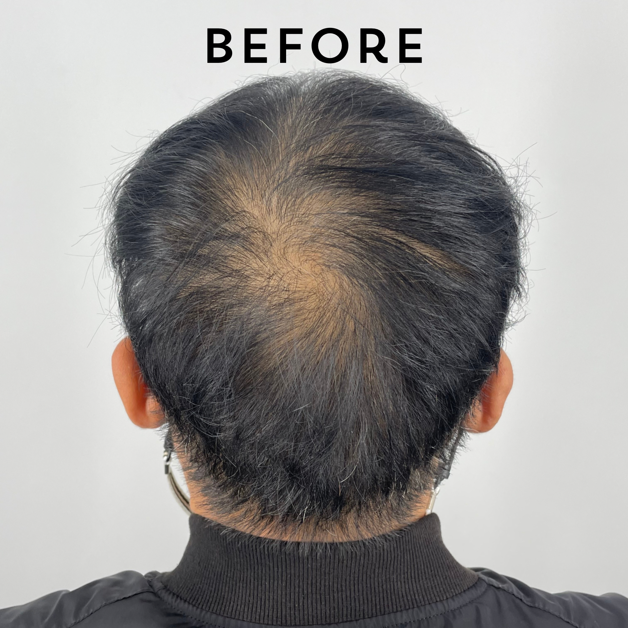 hair loss, smp, alopecia, hair growth