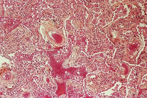 Ärrvävnad – hur den naturliga reparationen påverkar kroppens flöden