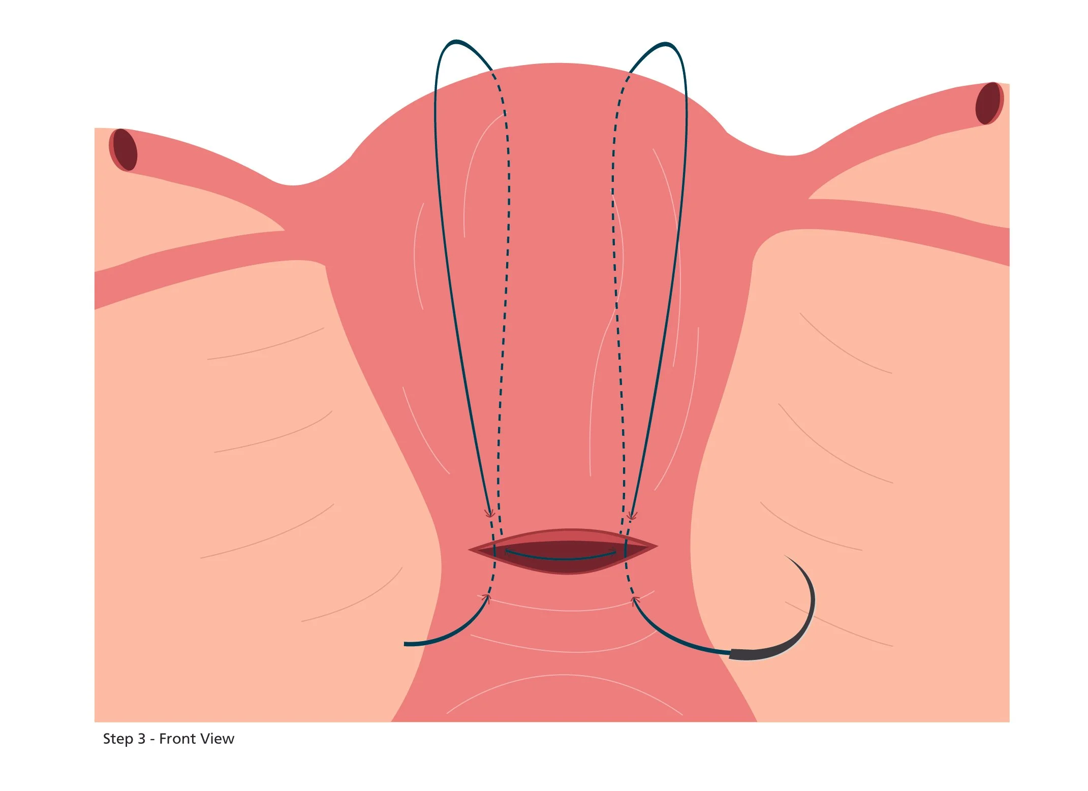 B-lynch Suture - Step3-rev1.jpg