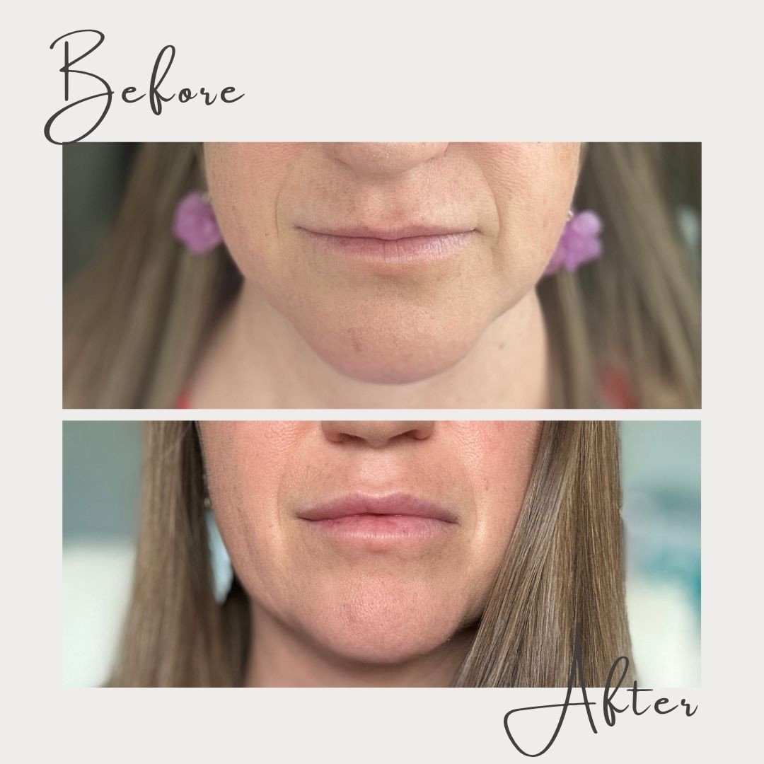 💋 When it comes to fillers, our philosophy is all about subtle, natural beauty. 💋⁠
⁠
For this client&rsquo;s transformation, we used the new Evolysse Smooth to balance and give her not only the volume she wanted, but accent that beautiful cupid&rsq