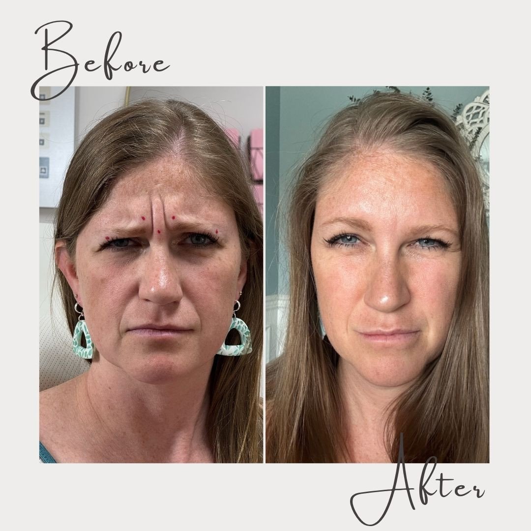 Subtle, natural, and SO satisfying ✨⁠
⁠
This client came in wanting to soften her deep-set 11&rsquo;s (those vertical lines between the brows) and get a bit of a lift to help her eyes look more open and refreshed&mdash;without looking overdone or fee