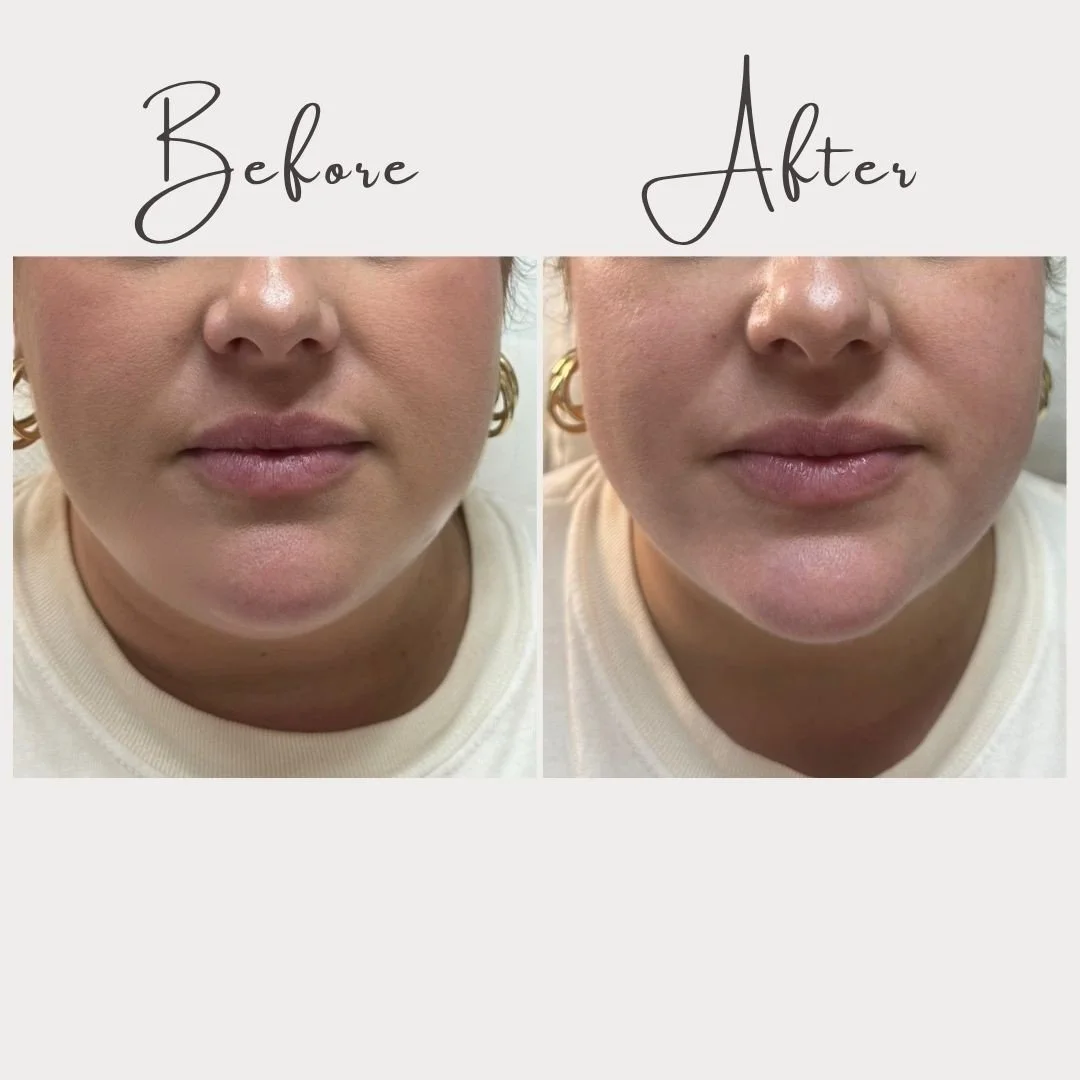 ✨WOW✨ Ladies and gents&hellip; this is your reminder that even the most subtle enhancements can make a seriously powerful impact. 💫⁠
⁠
A small amount of dermal filler around the chin and jawline &mdash; and just look at that transformation! Instantl