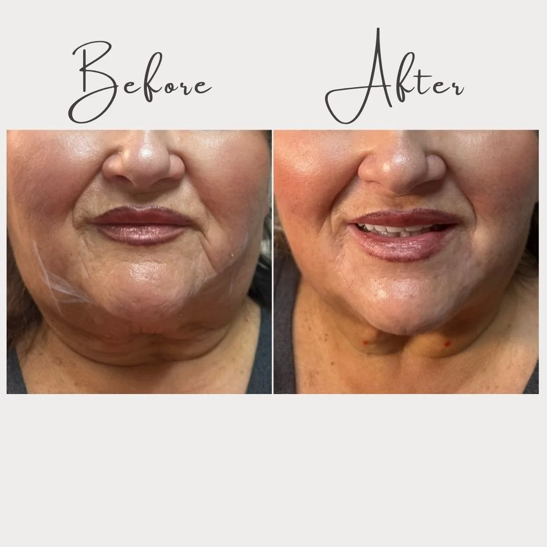✨Another incredible transformation ✨⁠
⁠
Proof that sometimes, the smallest tweaks make the biggest difference. 💉 Just a touch of dermal filler to the chin and jawline &mdash; and WOW. Instantly more definition and confidence.⁠
⁠
This is the power of