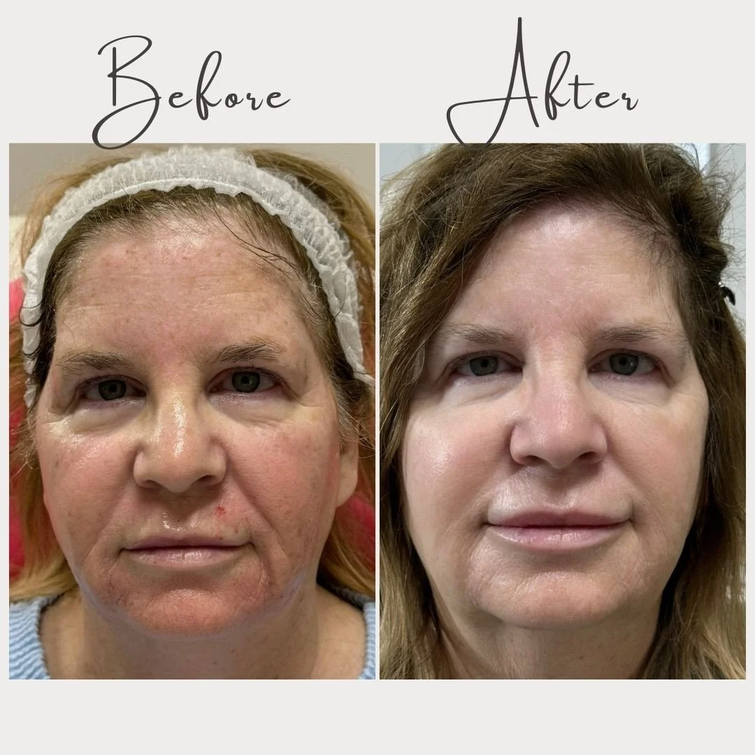 Radiant, refreshed, and naturally elevated. ✨⁠
Her &lsquo;after&rsquo; photo speaks for itself &mdash; brighter skin, softened texture, a fresh, firm complexion, and an even skin tone that looks absolutely stunning. And those sun spots? Gone. 🙌⁠
⁠
W