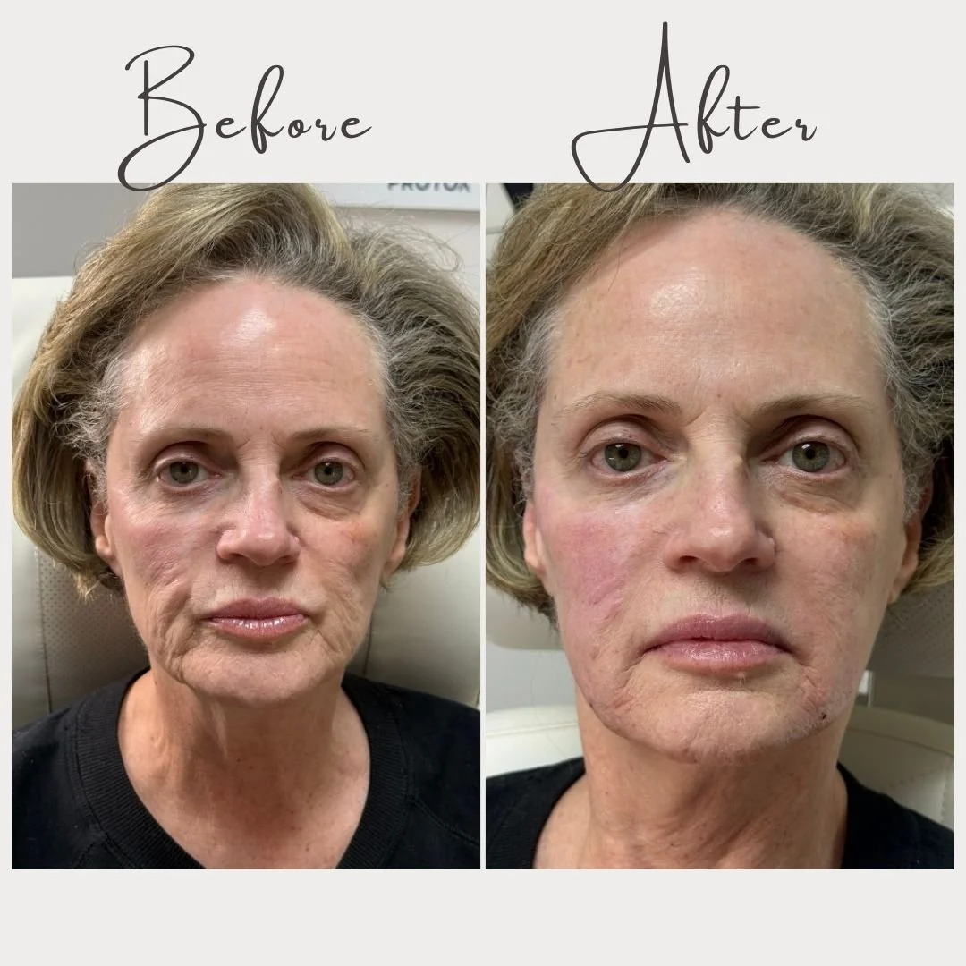There are moments in this work that remind us exactly why we do it. ✨🪞

This smile line and nasolabial fold transformation was one of those moments. The improvement was visible, meaningful, and completely aligned with her goals.

Carissa treated thi
