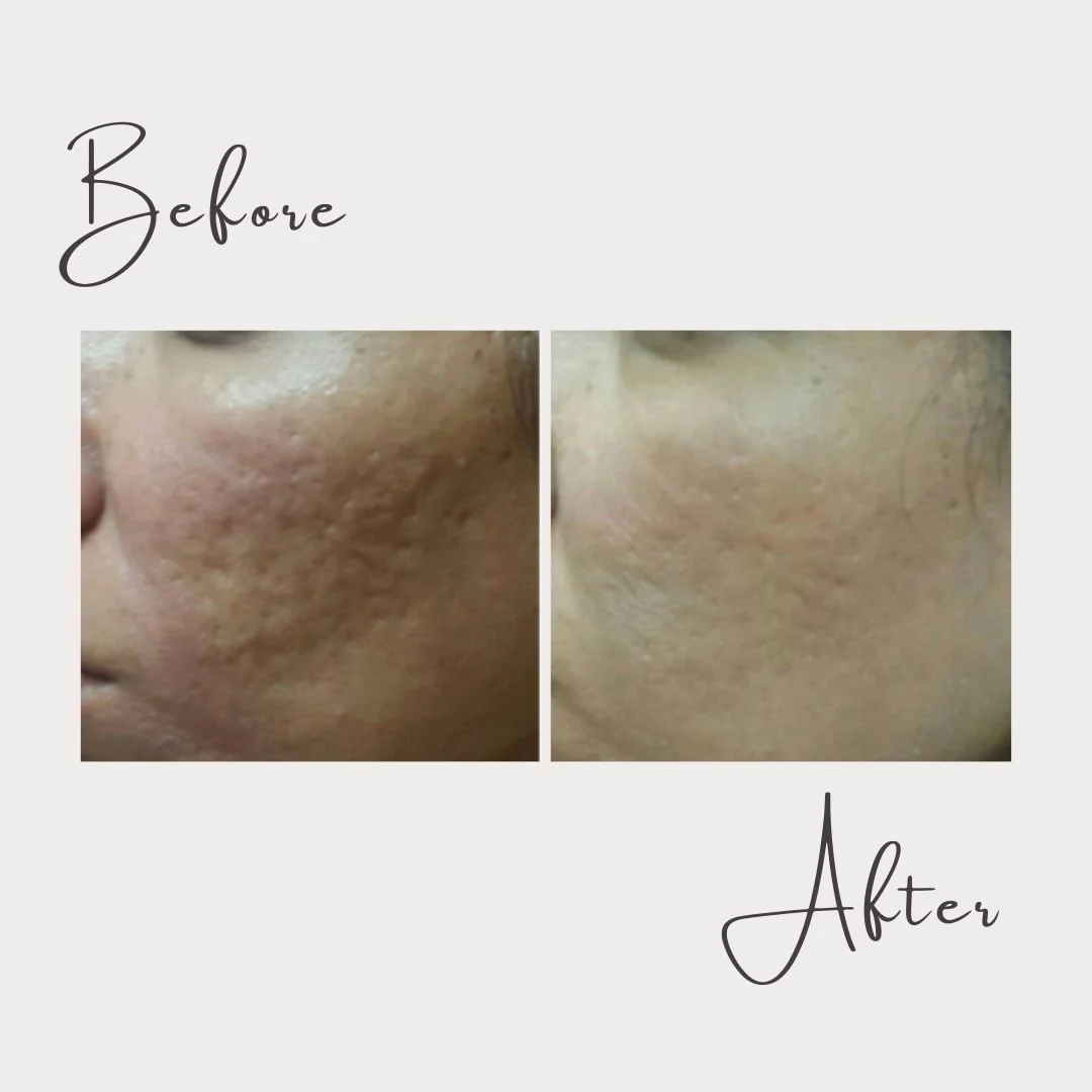 When it comes to acne scarring - you absolutely never have to resolve to just live with those scars! 🚫 Not on our watch!

✨ Our microneedling treatment is one of the few treatments available that will effectively minimize acne scarring and improve s
