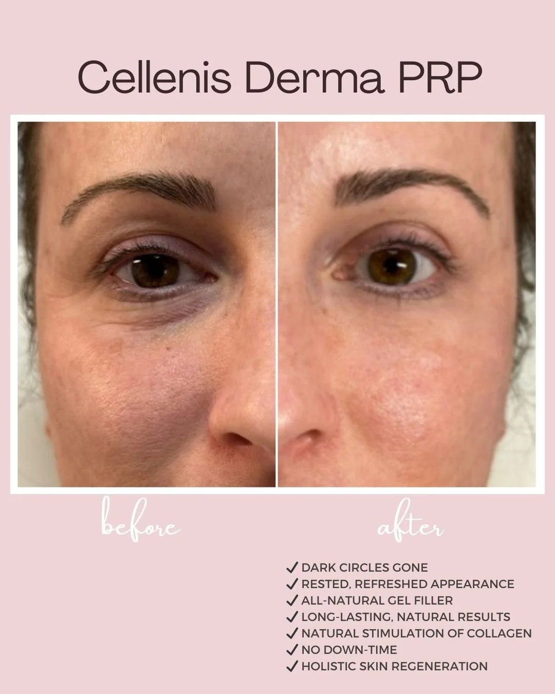 ✨ Unlock the power of your own body&rsquo;s healing abilities! ✨

Cellenis Derma PRP Gel Filler uses your body's natural platelet-rich plasma (PRP) to restore lost volume and rejuvenate your skin. It&rsquo;s a holistic and all-natural way to enhance 