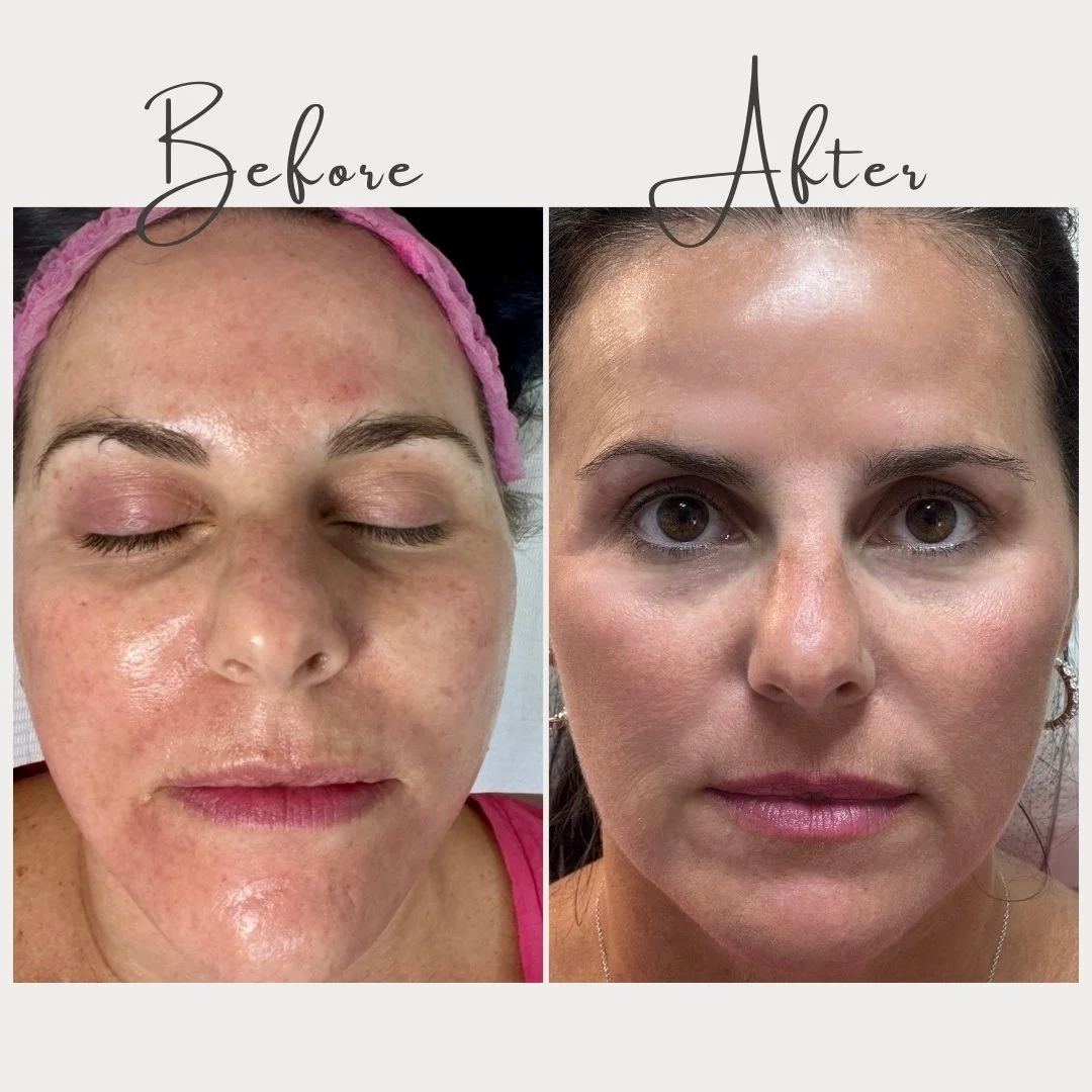 🌟 Fresh, even-toned, smooth skin&hellip; yes please ✨

💉 Microneedling with our Collagen PIN device creates thousands of tiny microchannels in your skin, which triggers your body&rsquo;s natural healing response. This boosts collagen + elastin prod