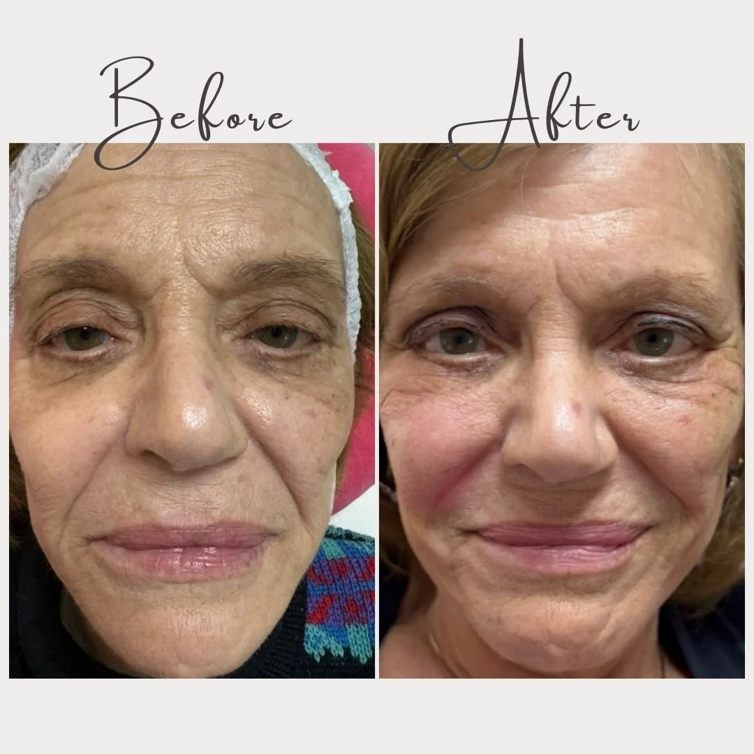 Sometimes the most beautiful results come from treating the skin and structure together ✨

This patient received a combination of Cellenis Derma PRP and microneedling, and the results speak for themselves. Her eyes and cheeks appear more lifted and s