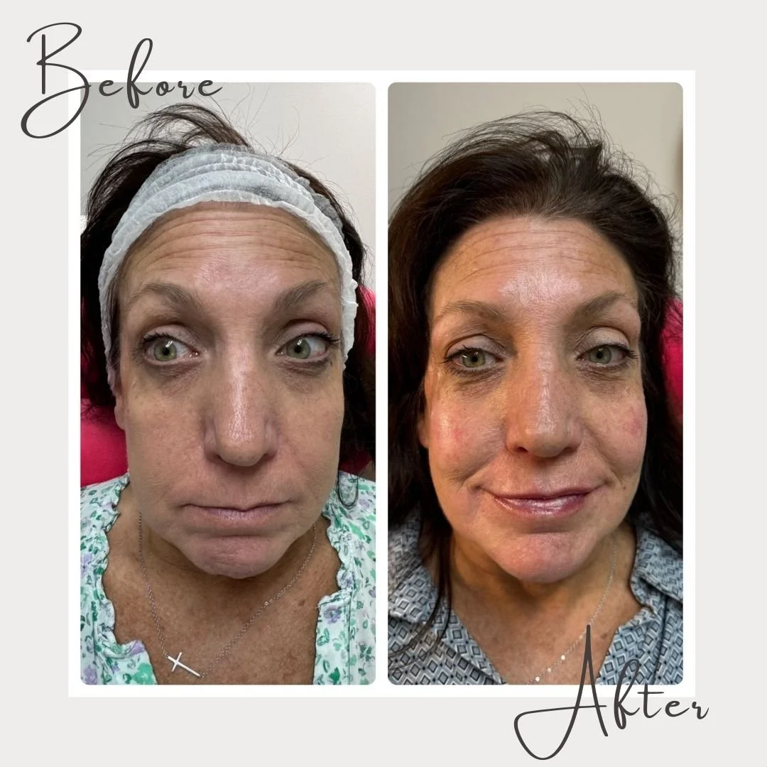 🌟 Check out this stunning transformation of our sweet client who visited us for cheek and lip filler!

I&rsquo;ve said before, and I&rsquo;ll die on this hill - Prioritizing yourself isn&rsquo;t selfish - it&rsquo;s essential to self-care.

Our clie