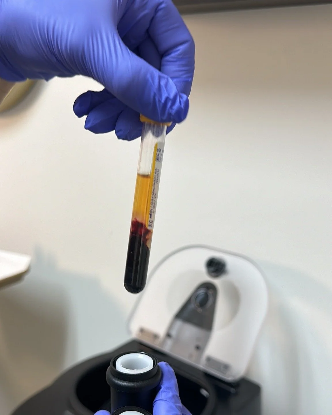 ✨ Have you been considering PRP Therapy for hair re-growth, restoring lost volume to your facial features, or even smoothing out deep set wrinkles or lines? ✨

We might be biased, 😘 but let&rsquo;s talk about why our Cellenis Derma PRP treatment mig