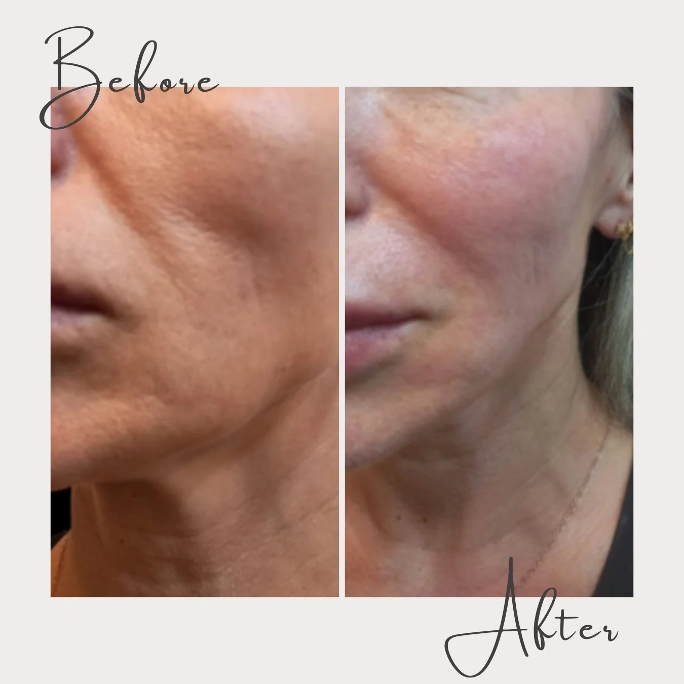 As we age, it's natural for our skin to lose elasticity, causing sagging in areas like the jowls and a decrease in volume in the face, due to a gradual decline in collagen production &amp; a breakdown of the skin's underlying structure. But there's a