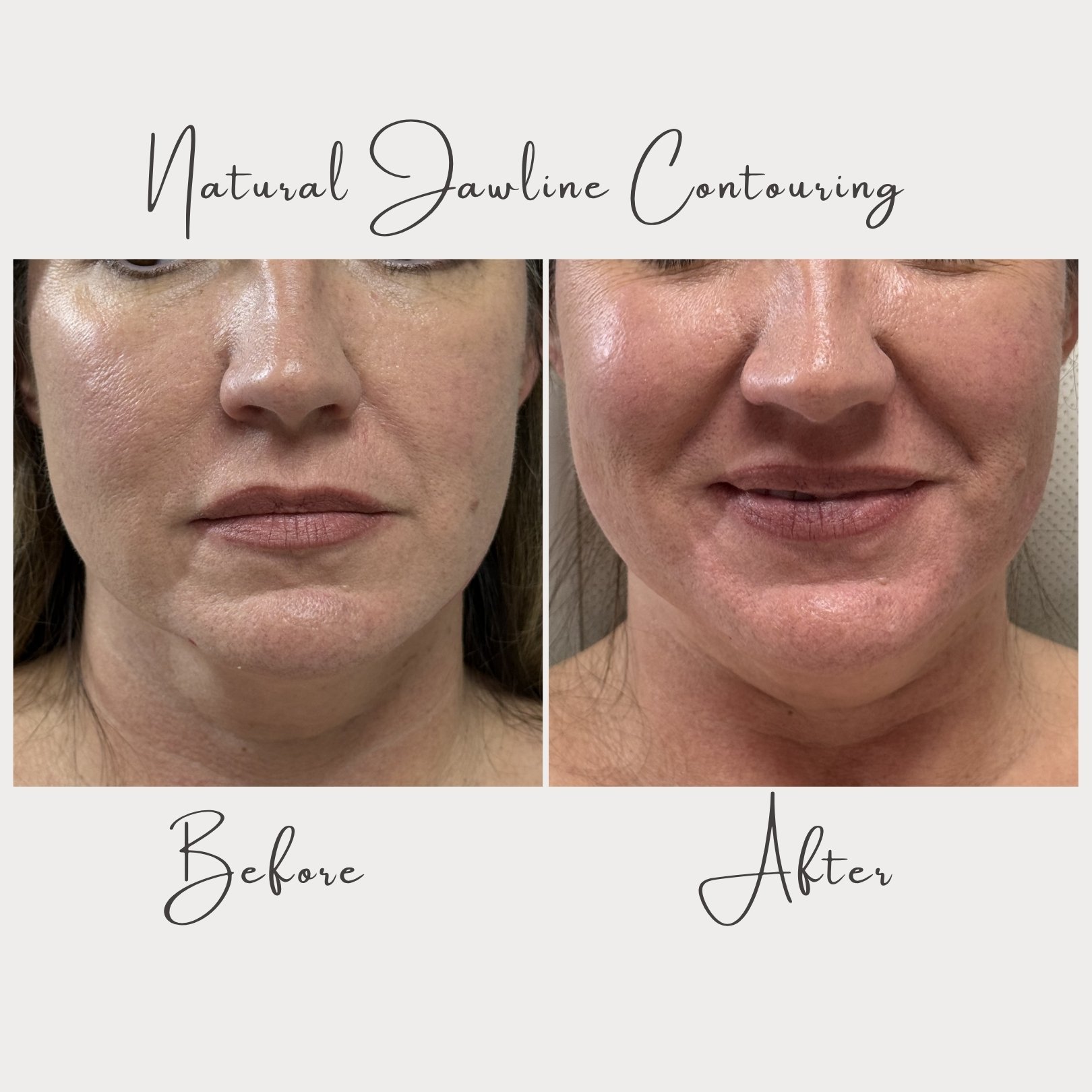 One of our favorite things about aesthetics is that sometimes the most powerful changes are the subtle ones. ✨

This beautiful result was achieved through a personalized jawline contouring treatment designed specifically for her anatomy, facial balan