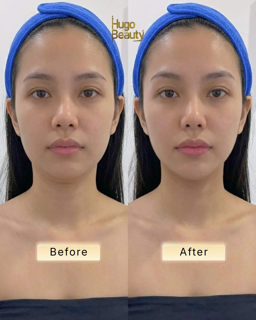 Liệu trình HIFU săn chắc da vùng cổ tại Hugo Beauty TP.HCM