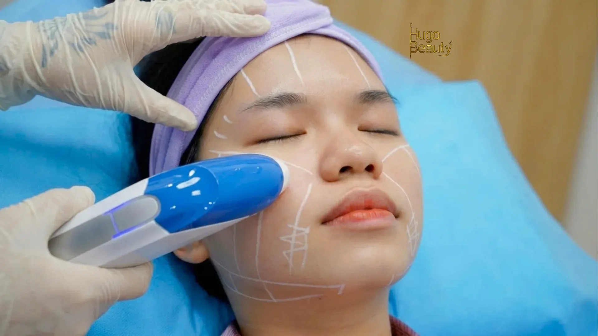 Client receiving HIFU facial lifting at Hugo Beauty in Phu Nhuan, Ho Chi Minh City