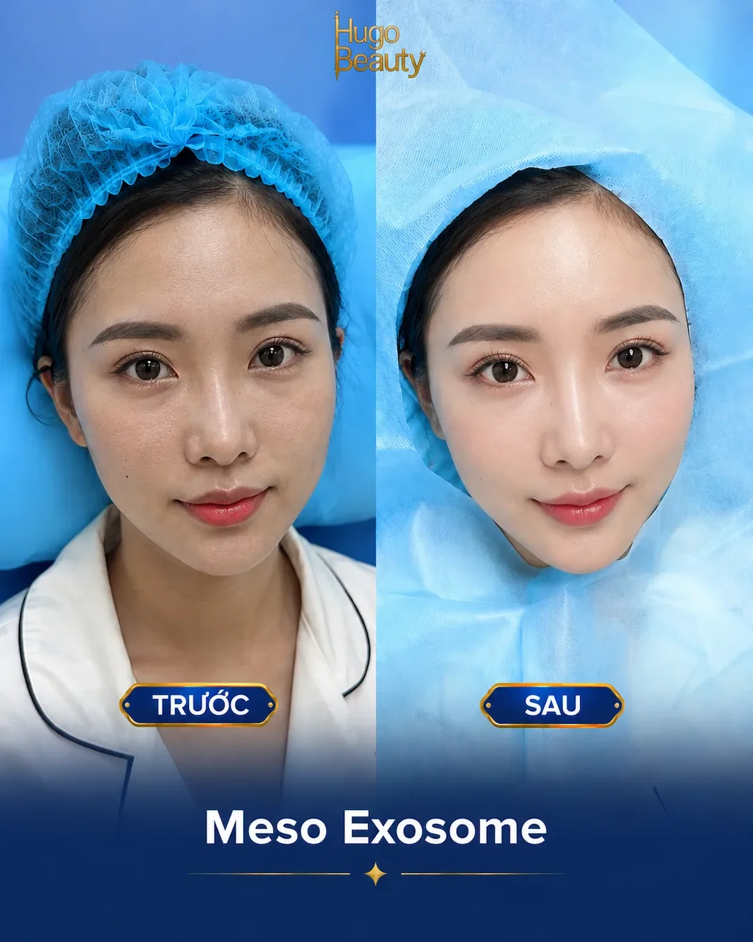 Hình ảnh trước và sau trẻ hóa da Meso Exosome tại Hugo Beauty với làn da căng bóng, mịn màng và rạng rỡ tự nhiên