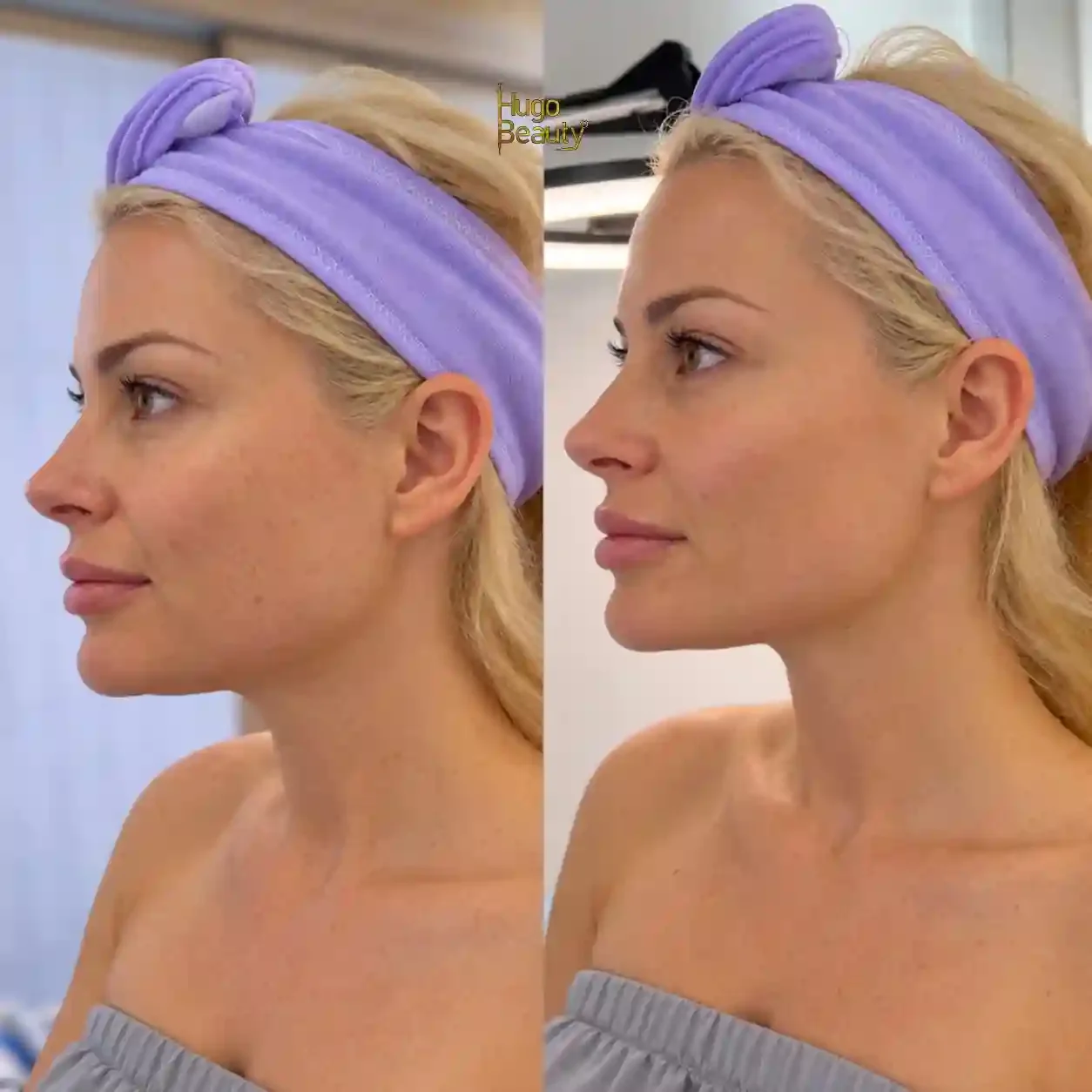 Side profile before and after HIFU showing a client’s jawline and under-chin at Hugo Beauty, Ho Chi Minh City