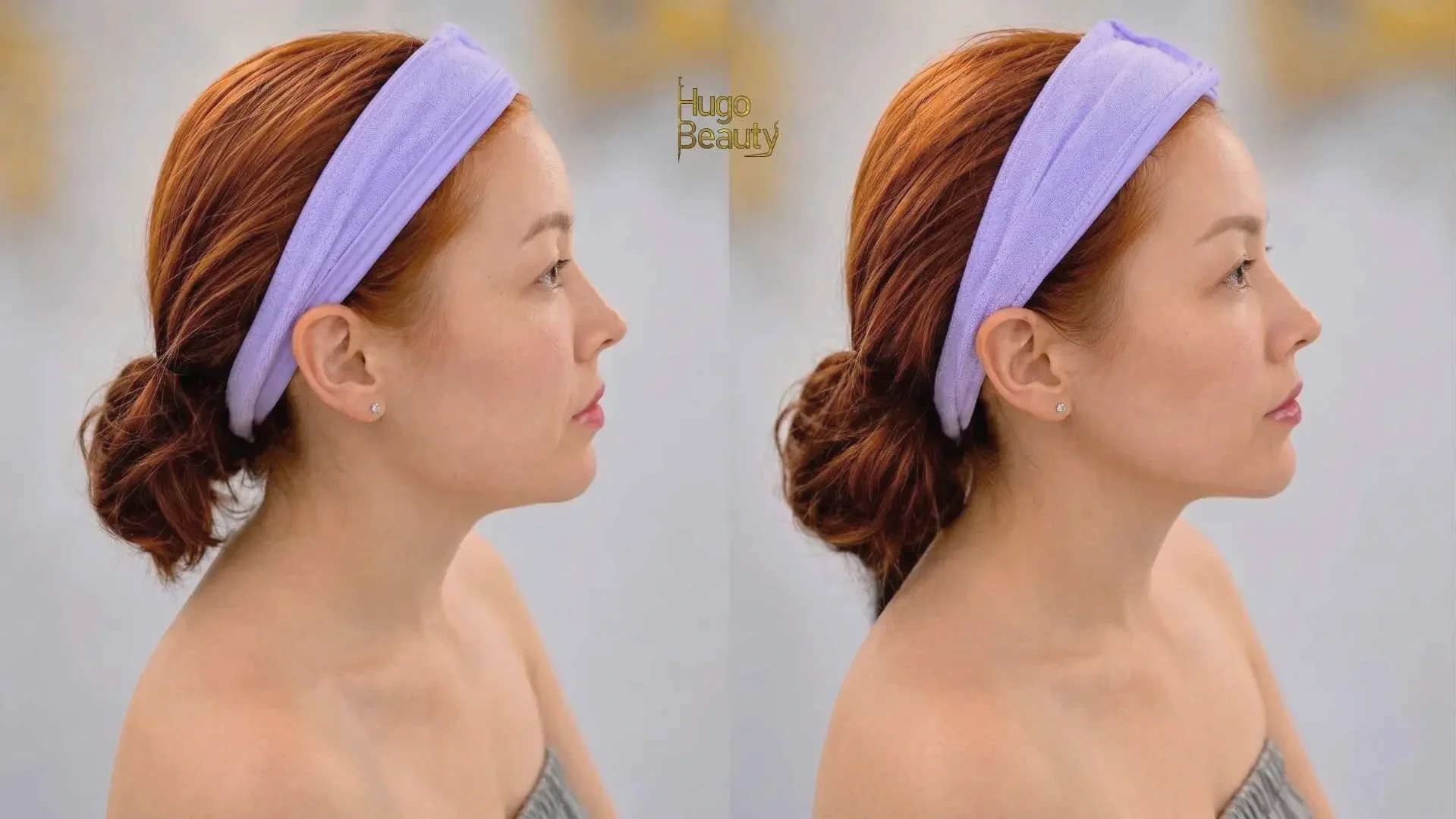 ết quả trước và sau nâng cơ HIFU thon gọn viền hàm tại Hugo Beauty Tp. HCM