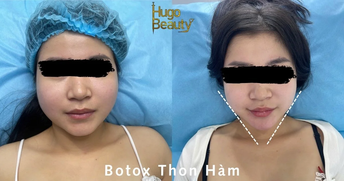 Tiêm Botox Thon Hàm - Giải Pháp Hiệu Quả Cho Khuôn Mặt Thon Gọn