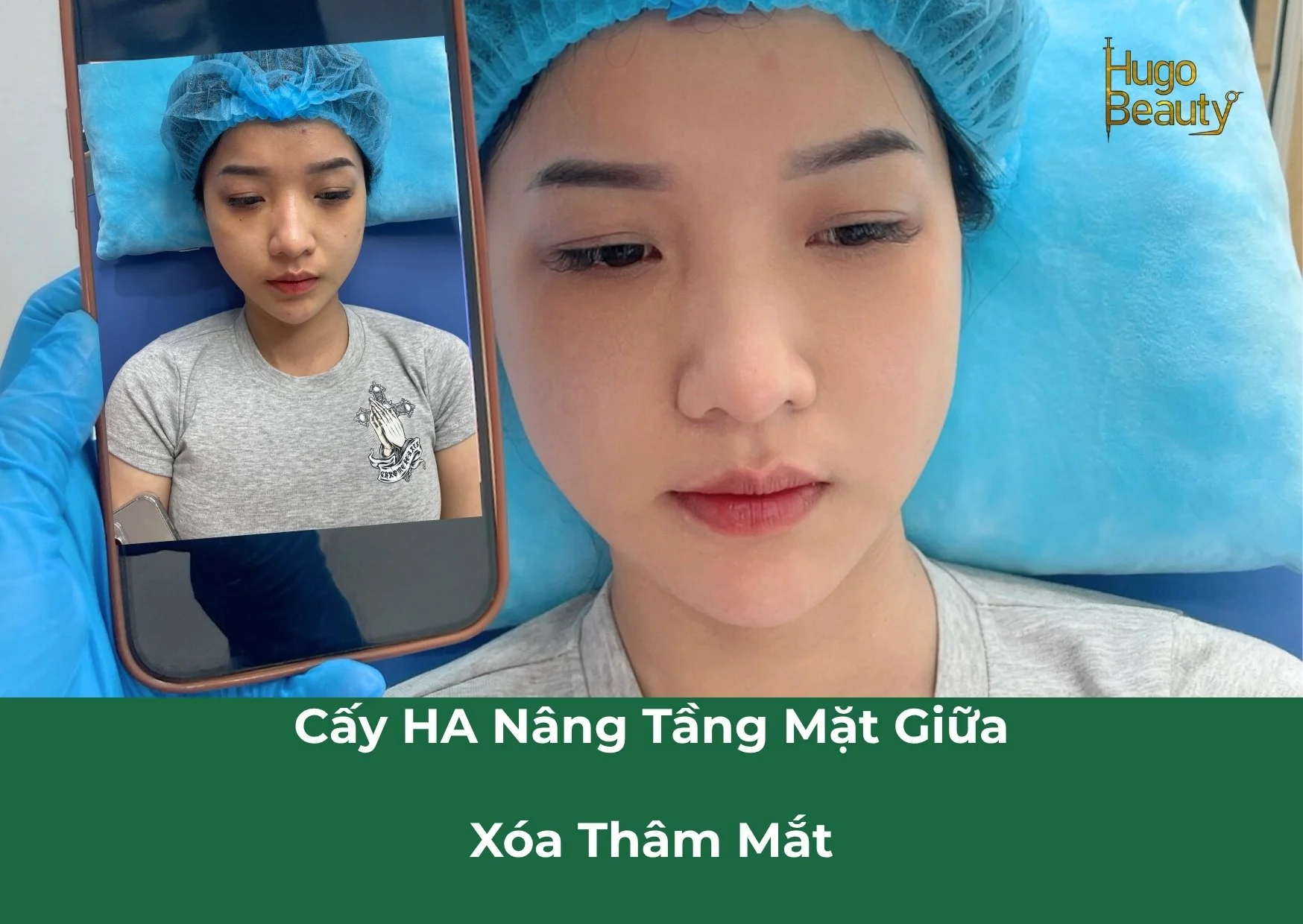 Nâng cơ tầng mặt giữa là gì? Giải pháp trẻ hóa tự nhiên tại Hugo Beauty