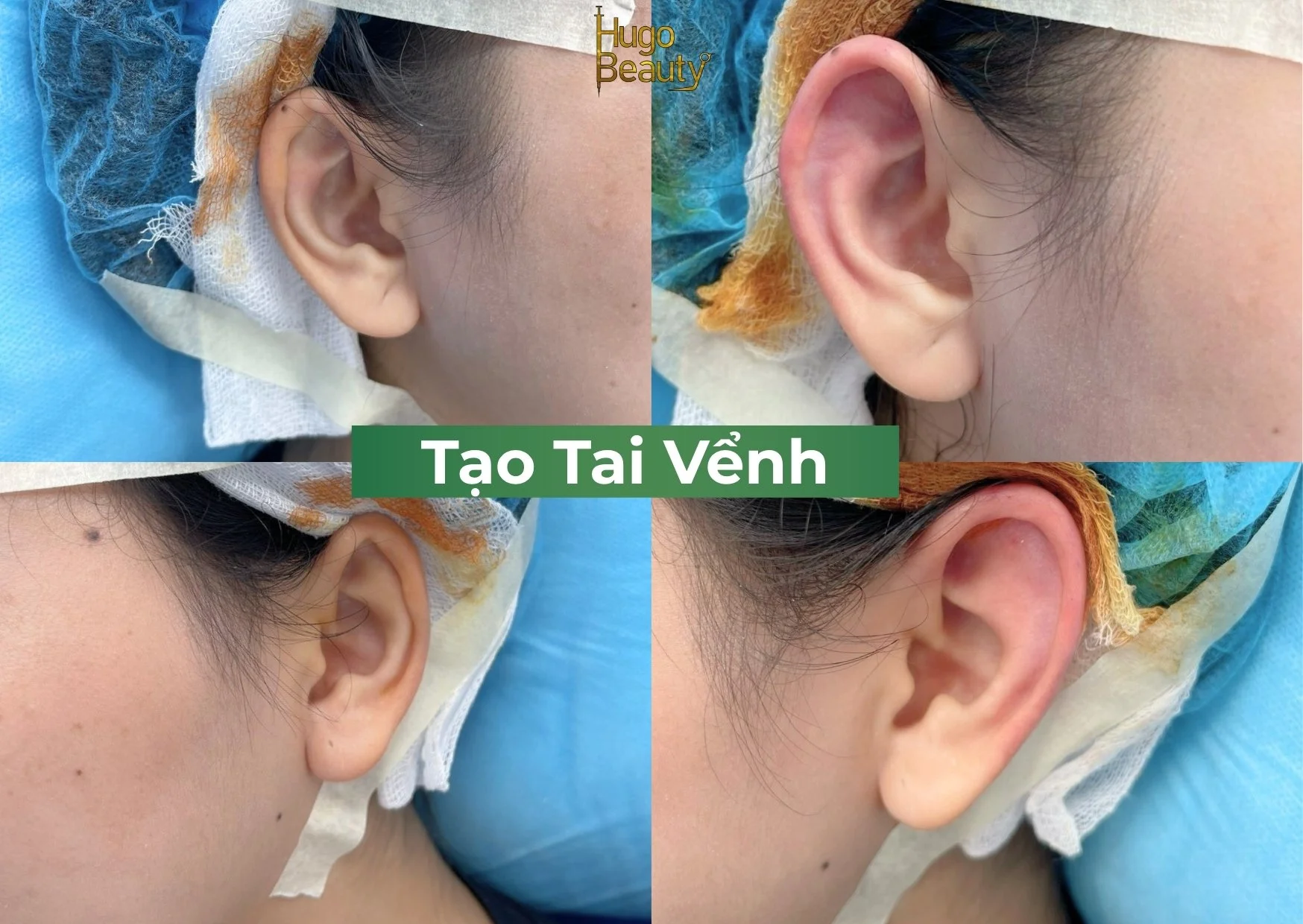 Tiêm Tai Vểnh Là Gì? Giải Pháp Thẩm Mỹ Đôi Tai Đẹp Tự Nhiên & Hợp Phong Thủy