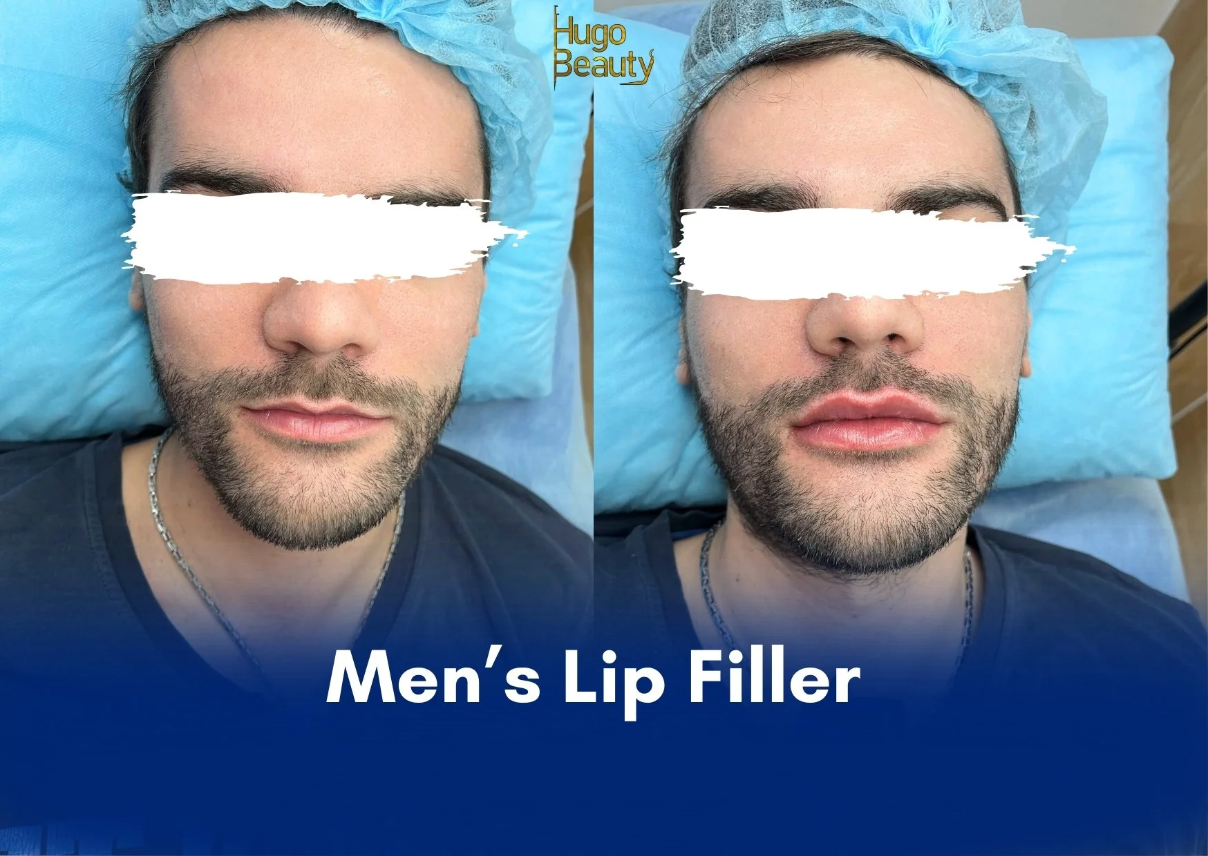 Men’s Lip Filler – Tiêm Filler Môi Nam Tự Nhiên, Nam Tính Tại TP.HCM