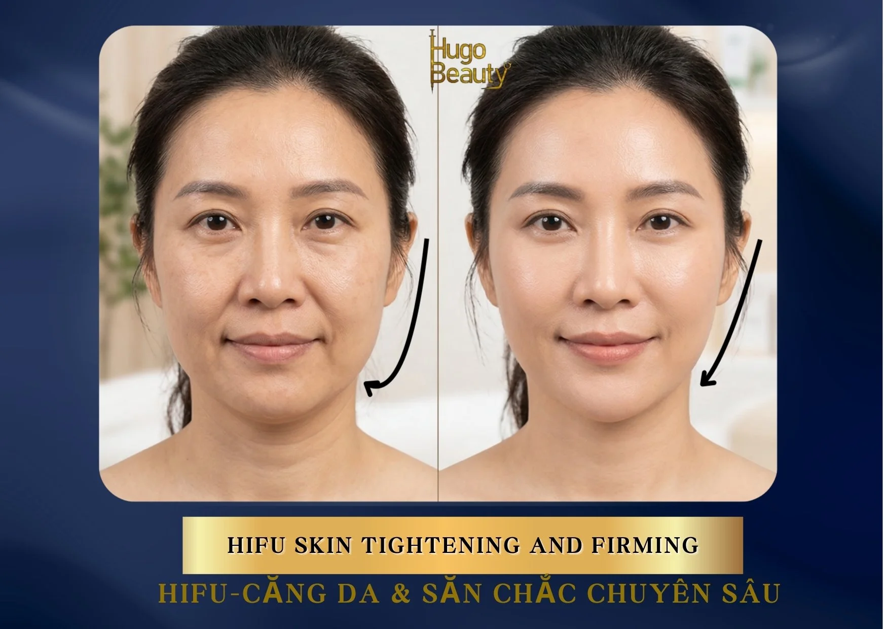 HIFU Lifting – Advanced Skin Tightening and Firming in Ho Chi Minh City