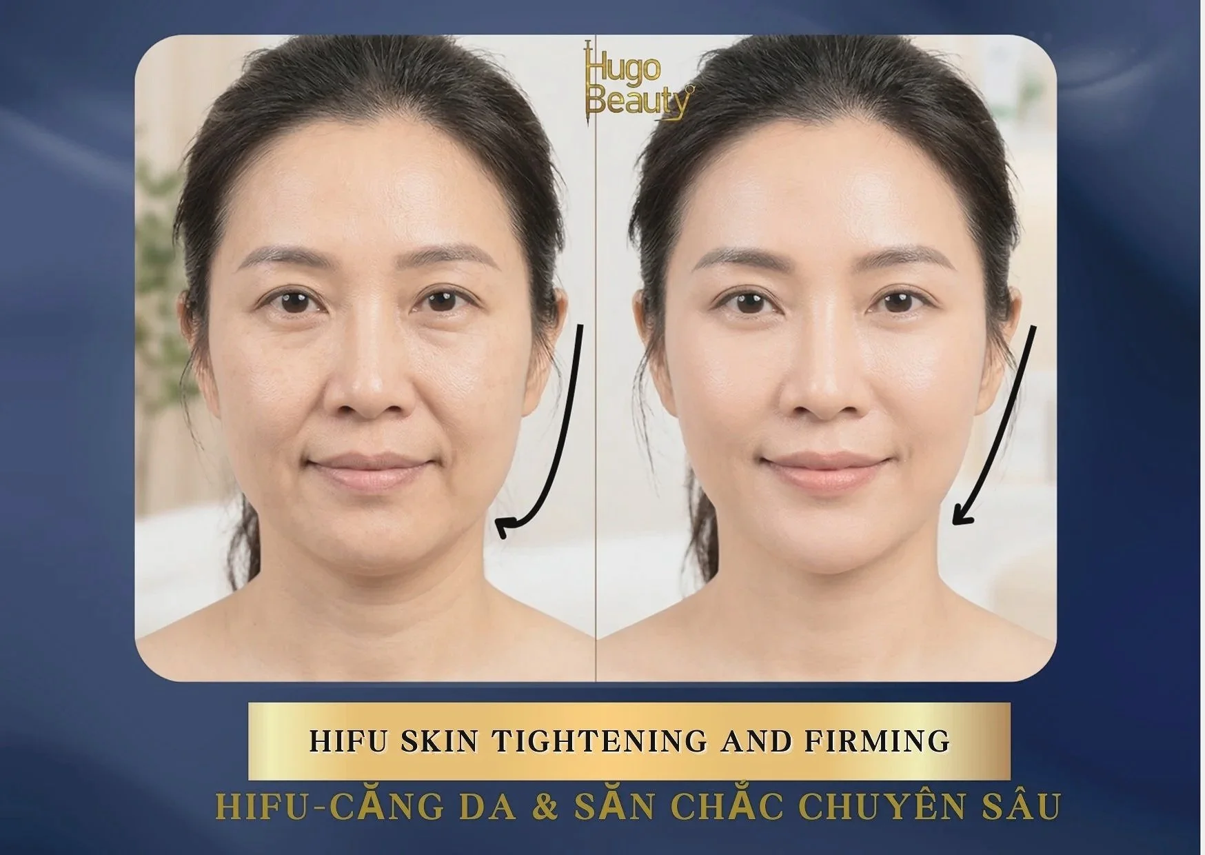 HIFU Lifting – Advanced Skin Tightening and Firming in Ho Chi Minh City