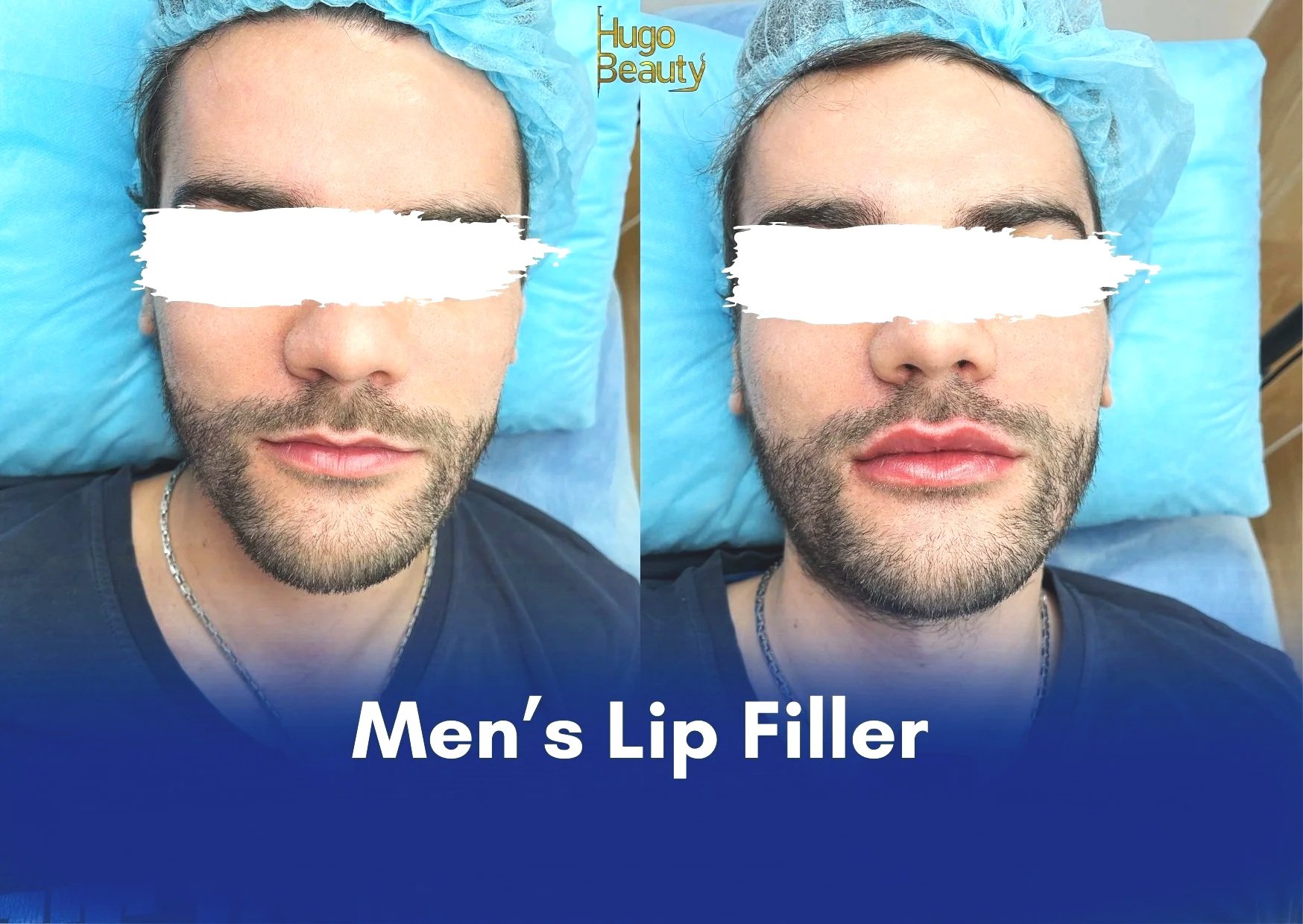 Men’s Lip Enhancement – Tạo hình môi nam tự nhiên tại TP.HCM