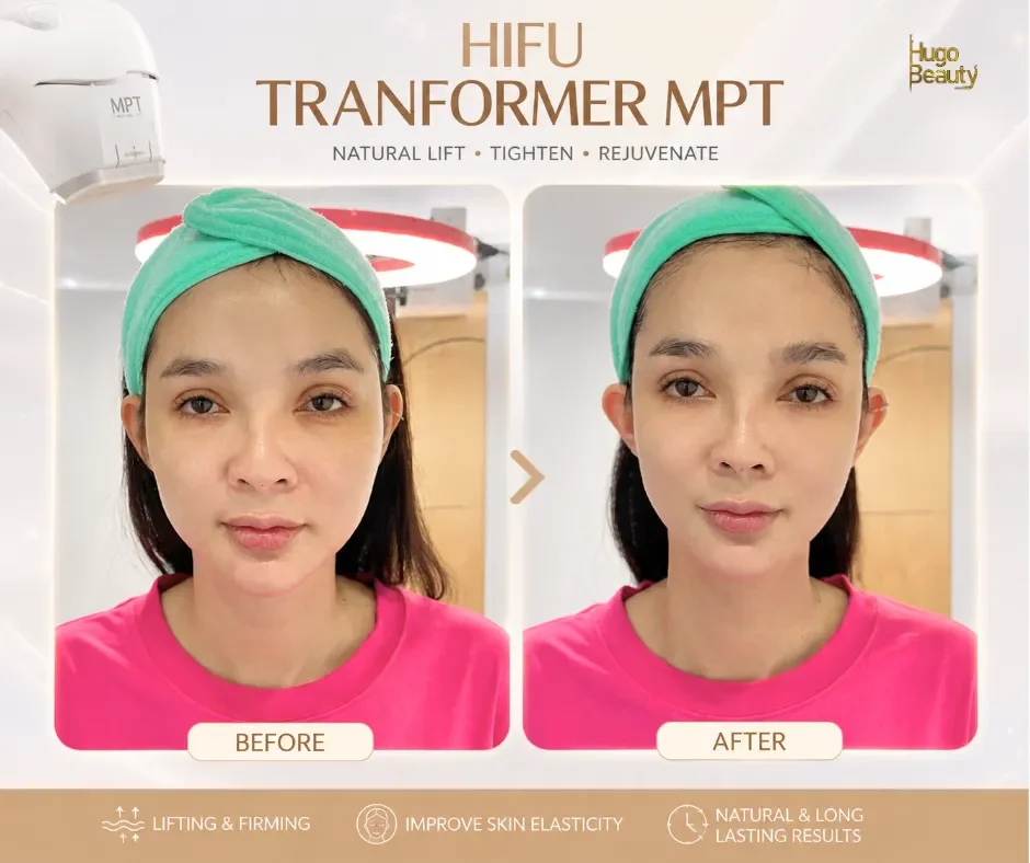 HIFU Skin Tightening with Ultraformer MPT in Ho Chi Minh City