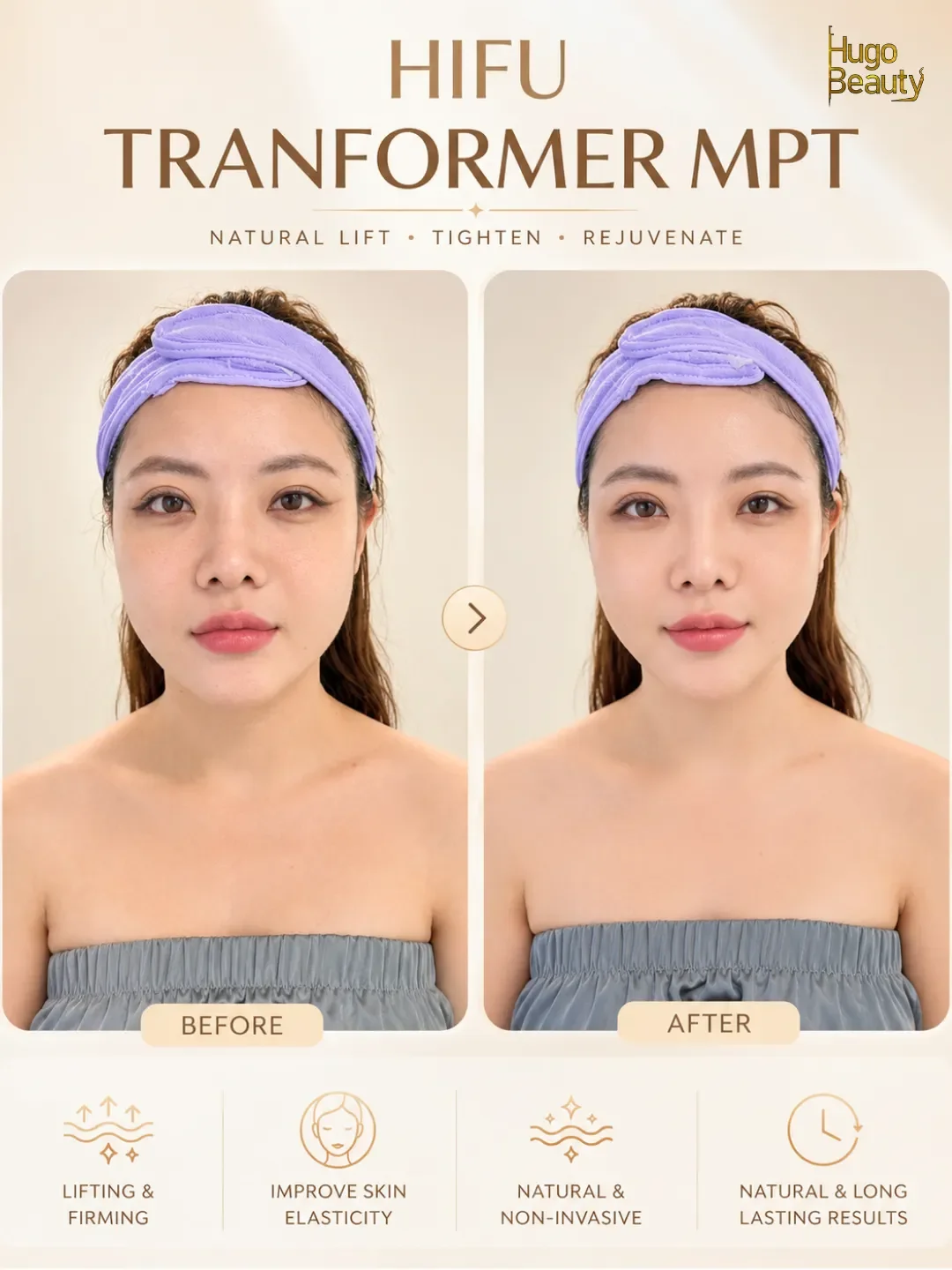 Before and after Ultraformer MPT HIFU treatment at Hugo Beauty in Ho Chi Minh City