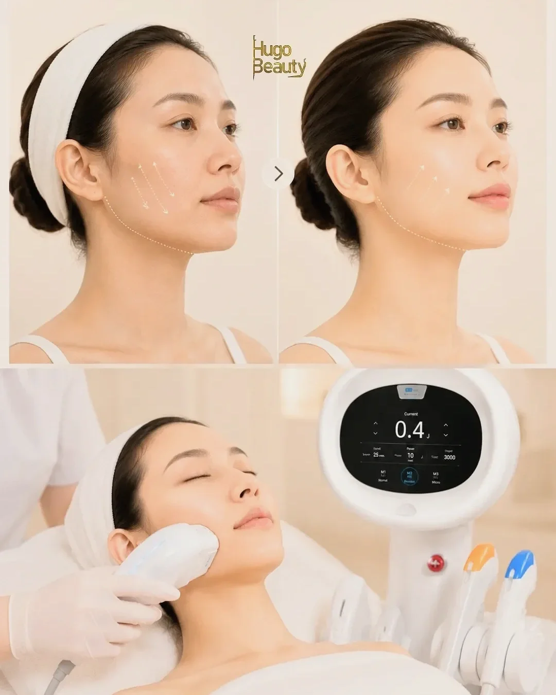 How Often Should You Have HIFU? Recommended HIFU Treatment Frequency