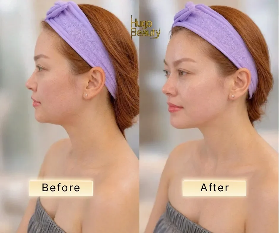 HIFU vs Thermage FLX: Which Is Better for Sagging Skin?
