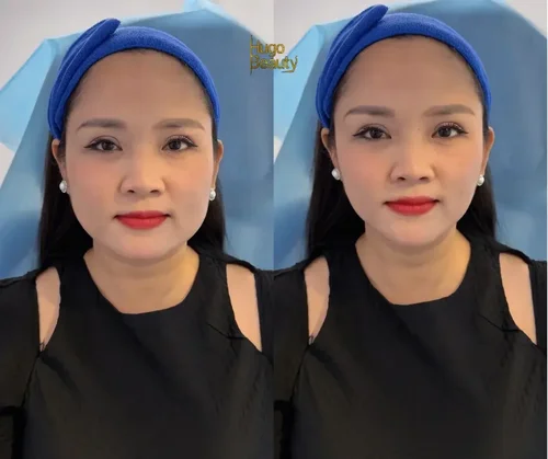 Before and after full-face skin tightening at Hugo Beauty