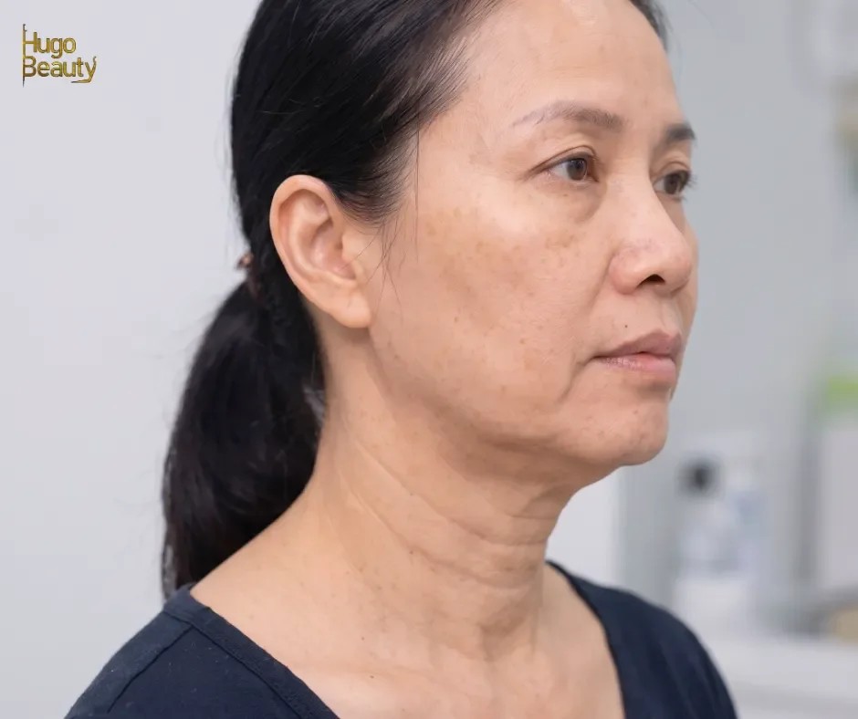 HIFU, căng chỉ hay chất làm đầy: ba cơ chế khác nhau cho cùng một câu “mặt em bị chảy xệ”