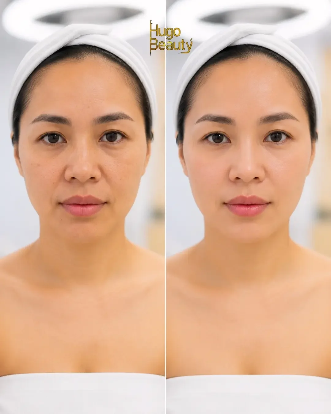 HIFU for the Forehead and Eye Area: What 1.5–2.0 mm Can Do, and Where Botox Takes Over
