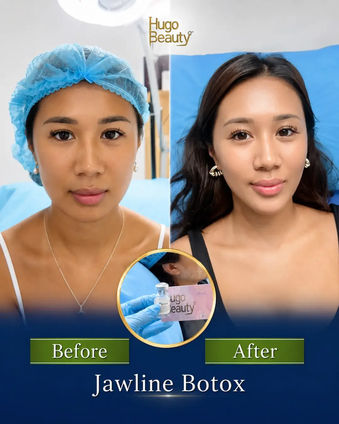 Hình ảnh trước và sau botox gọn hàm tại Hugo Beauty giúp khuôn mặt thon gọn và cân đối tự nhiên