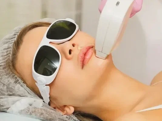 Khách nữ đeo kính bảo hộ khi triệt lông bằng laser diode vùng cằm và môi trên – triệt lông mặt và mép tại Hugo Beauty TP.HCM