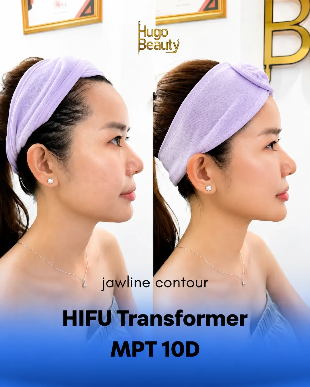 Kết quả HIFU jawline sau 10 ngày giúp gương mặt săn chắc và thon gọn tự nhiên tại Hugo Beauty