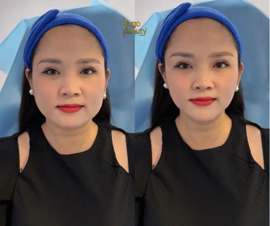 Before-and-after HIFU results showing a firmer jawline and lifted lower face at Hugo Beauty