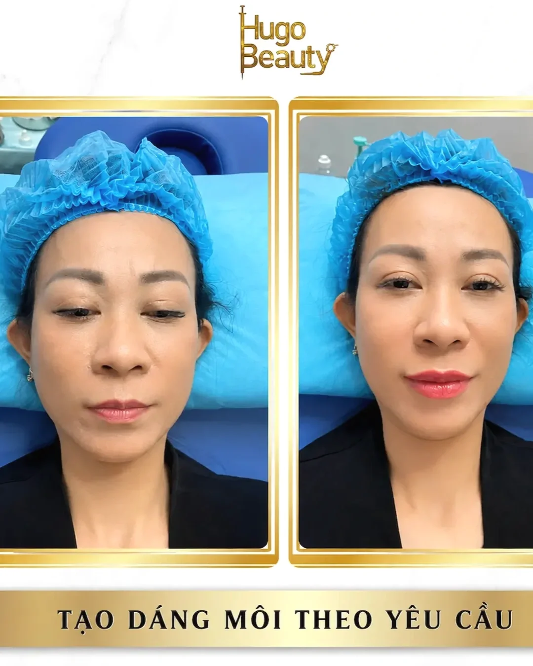 Side-by-side comparison of a woman before and after cosmetic lip enhancement at Hugo Beauty, lying on a medical bed with a blue hair cap, showing improved lip fullness and shape.