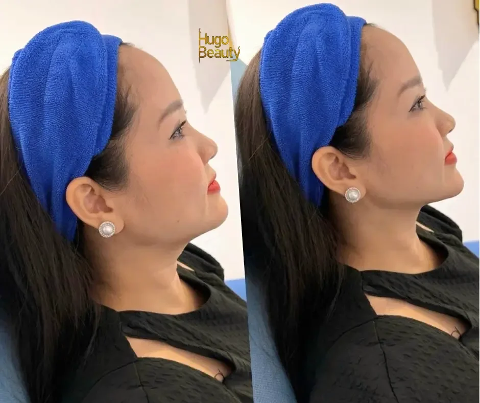Before-and-after HIFU jawline contouring results showing a firmer, more defined lower face at Hugo Beauty