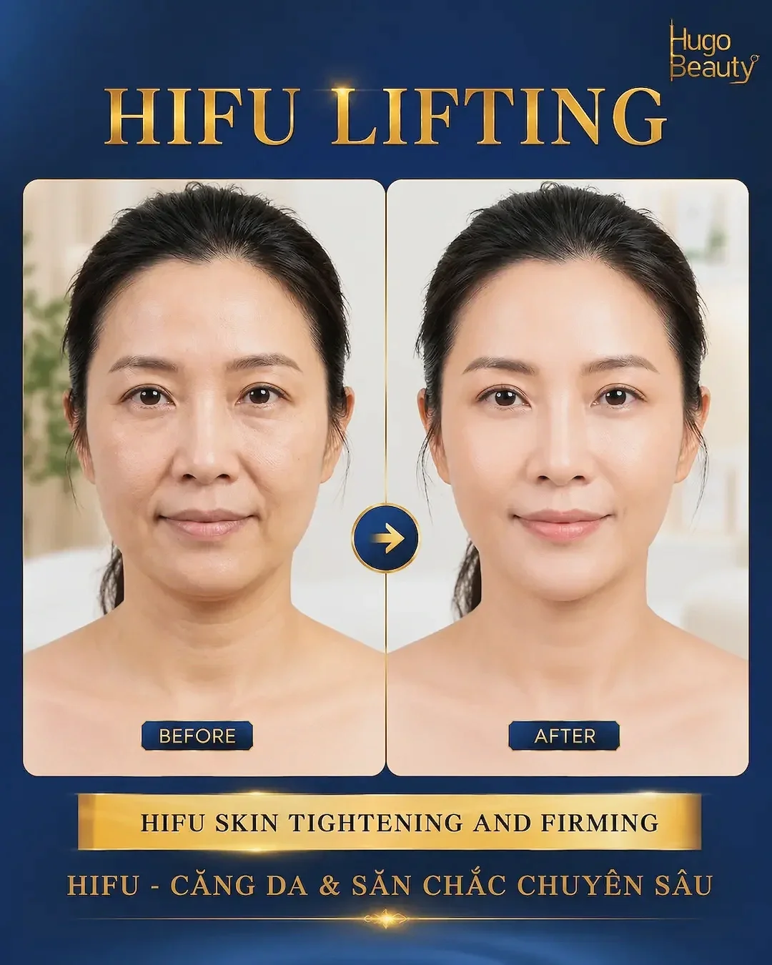 Hình ảnh trước và sau HIFU lifting tại Hugo Beauty giúp cải thiện độ săn chắc, nâng cơ và làm da căng mịn tự nhiên`