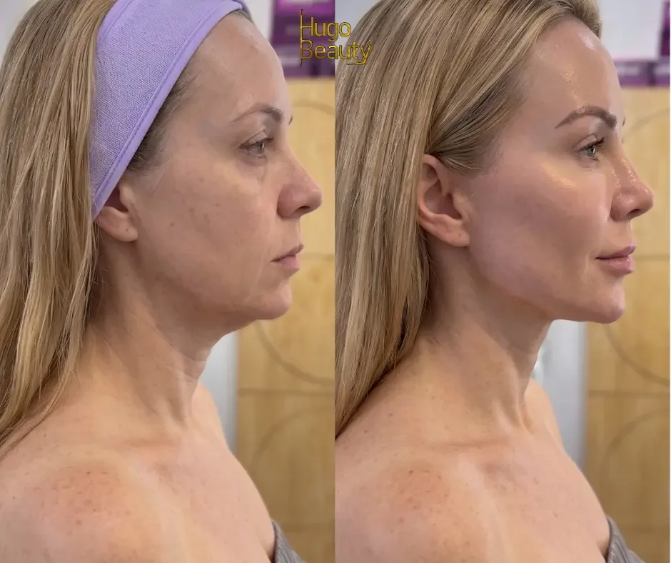 Cải thiện đường viền hàm jawline và giảm chùng nọng cằm bằng công nghệ nâng cơ HIFU