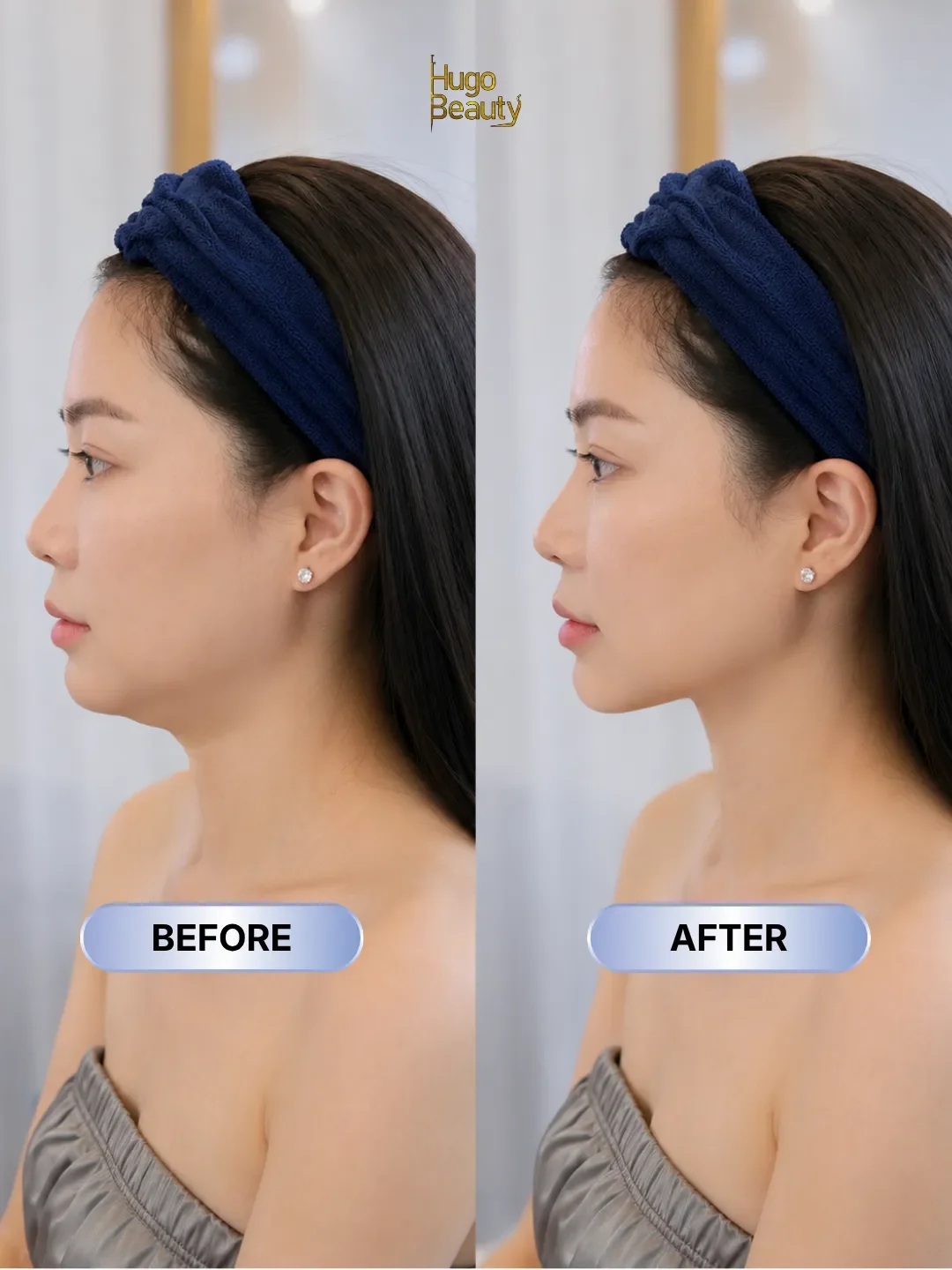 Ultraformer MPT HIFU double chin reduction before and after at Hugo Beauty Ho Chi Minh City